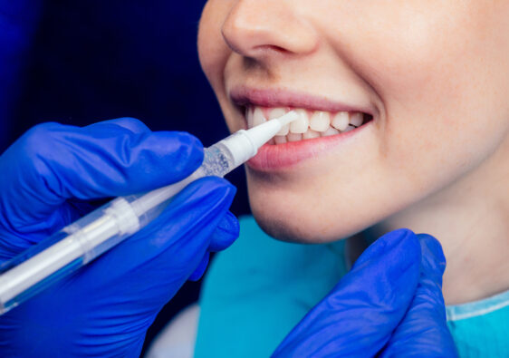 Jak działa technologia ICON w zatrzymywaniu postępu próchnicy?