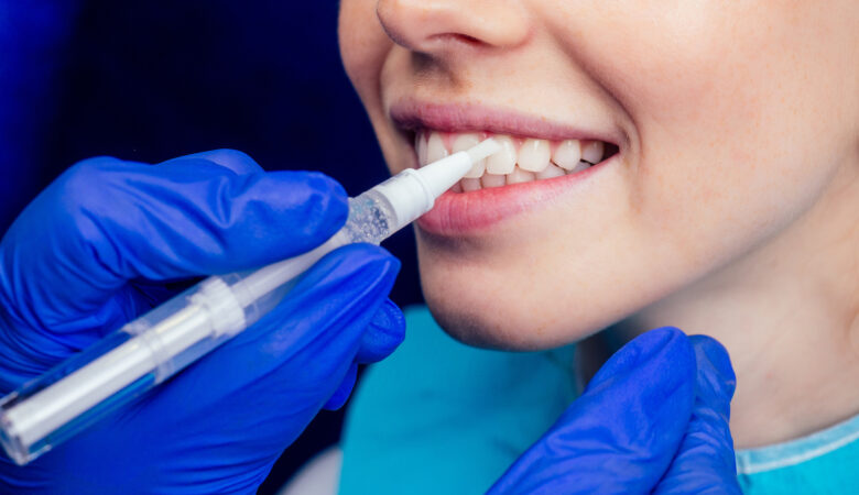 Jak działa technologia ICON w zatrzymywaniu postępu próchnicy?